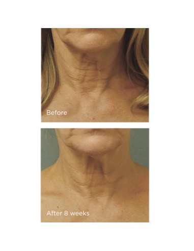 Cold Plasma Plus+ Neck & Chest SPF25